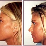 Хирургия профиля носа фото