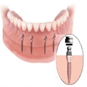 Зубные импланты фото