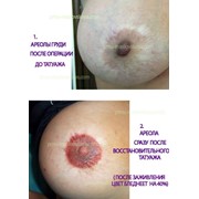 Восстановительный татуаж ареолы груди фото
