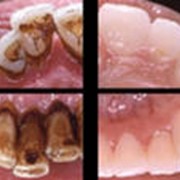Удаление зубного камня ультразвуковым скалером в алматы фото