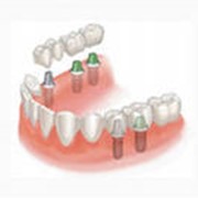 Установка зубного протеза на имплантаты в алматы фото
