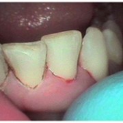 Лечение и реставрация зубов фото