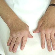 Лечение ревматоидного артрита в Алматы фото