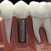 Установка зубного протеза