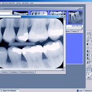 Компьютерная диагностика зубов