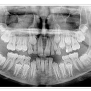 Панорамный рентген снимок зубов