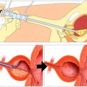 Лечение аденомы предстательной железы фотография