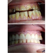 Эстетическое восстановление зубов. фотография