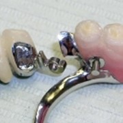 Бюгельное протезирование зубов фото