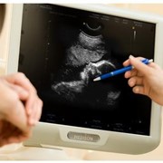 Пренатальная диагностика и ведения беременности фото
