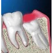 Удаление ретенированных и сложных зубов фотография