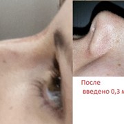 Коррекция спинки носа +увеличение губ фотография