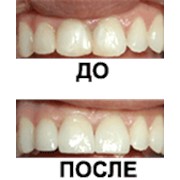 Протезирование зубов фотография