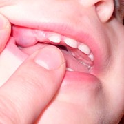Разрезы при прорезывании зубов фотография