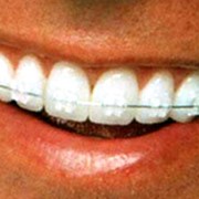 Выравнивание зубного ряда в Алматы фото