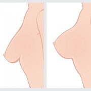 Подтяжка груди - мастопексия фото