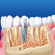 Имплантация зубов (материалы Южная Корея) фотография