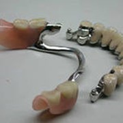 Протезирование зубов бюгельное