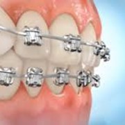 Ортодонтия. Лечение аномалий зубо-челюстной системы фотография