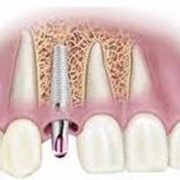 4D - зубная имплантология