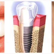 Имплантация зубов фото