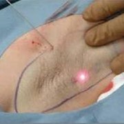 Гипергидроз: лазерное лечение (Ужгород), гипергидроз лазер, гипергидроз лечение. фото