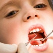 Серебрение зубов. Серебрение зубов у детей цена Киев. Серебрение зубов в Киеве фото