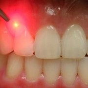 Лазерная стоматология в Алматы фото