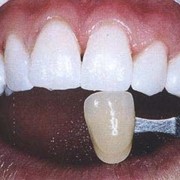 Лазерное отбеливание зубов фото