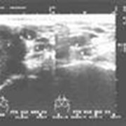 Ультразвуковая диагностика щитовидной железы фото