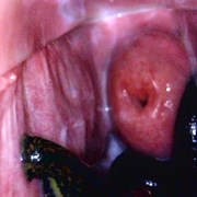 Внутривагинальная постановка пиявок в Виннице фото