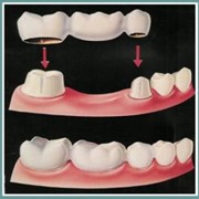 Протезирование зубов фото