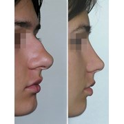 Ринопластика - изменение формы и размера носа