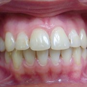 Протезирование зубов в алматы