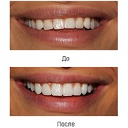Эстетические реставрации (устранение диастем и трем, поворотов зуба) фото