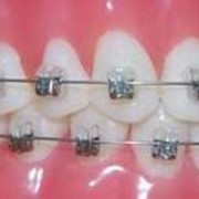 Исправление зубов у взрослых