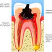 Лечение кариеса в алматы