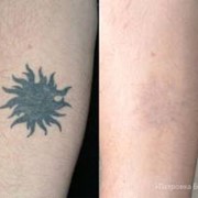 Удаление татуировок лазером, Львов фото
