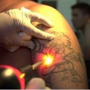 Удаление татуировок лазером, Украина фото
