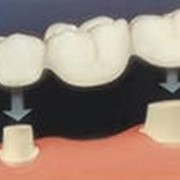 Протезирование зубов несъемное в Алматы