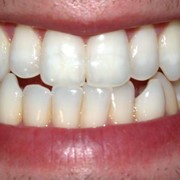 Эстетическое восстановление зубов