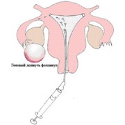 Внутриматочная инсеминация спермой мужа или донора в клинике BioTexCom фотография