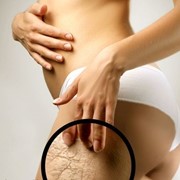 Лазерное удаление растяжек навсегда фото