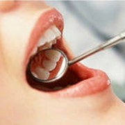 Лечение кариеса зубов ( в т.ч. ICON-без сверления)