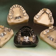 Протезирование зубов бюгельное фото