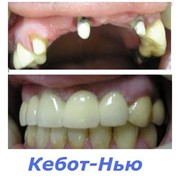 Протезирование зубов (коронки на оксиде циркония)